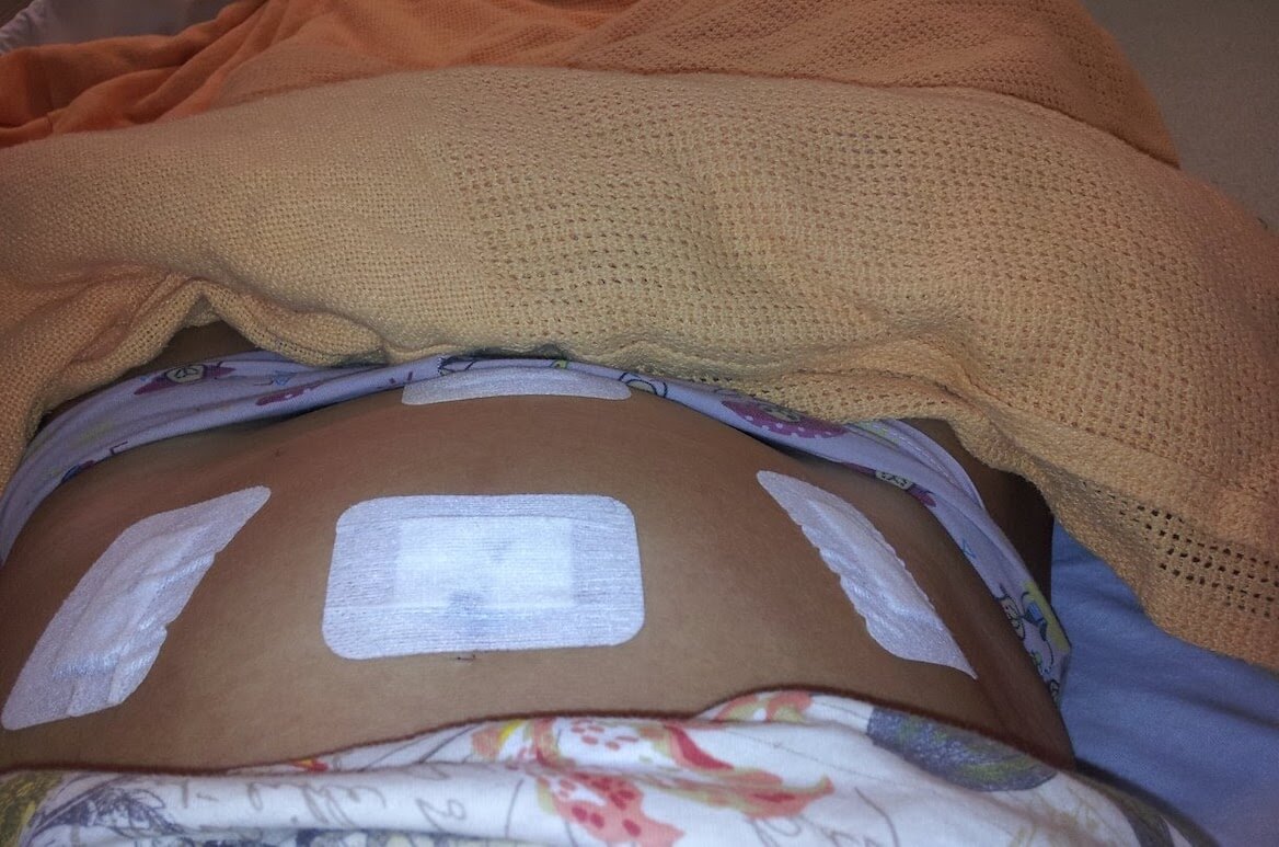 endometriosis